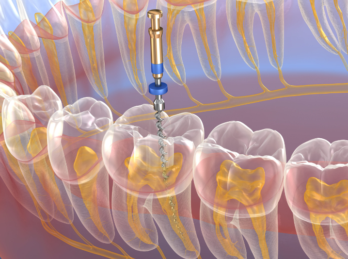 Root Canal Facts and Alternatives